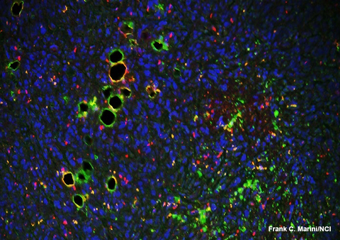 breast tumor microenvironment